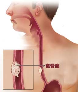 食道癌患者手术之后的饮食要注意事项